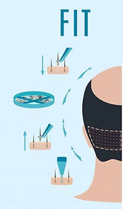 عکس گرافیکی کاشت مو به روش fit برای درمان ریزش مو